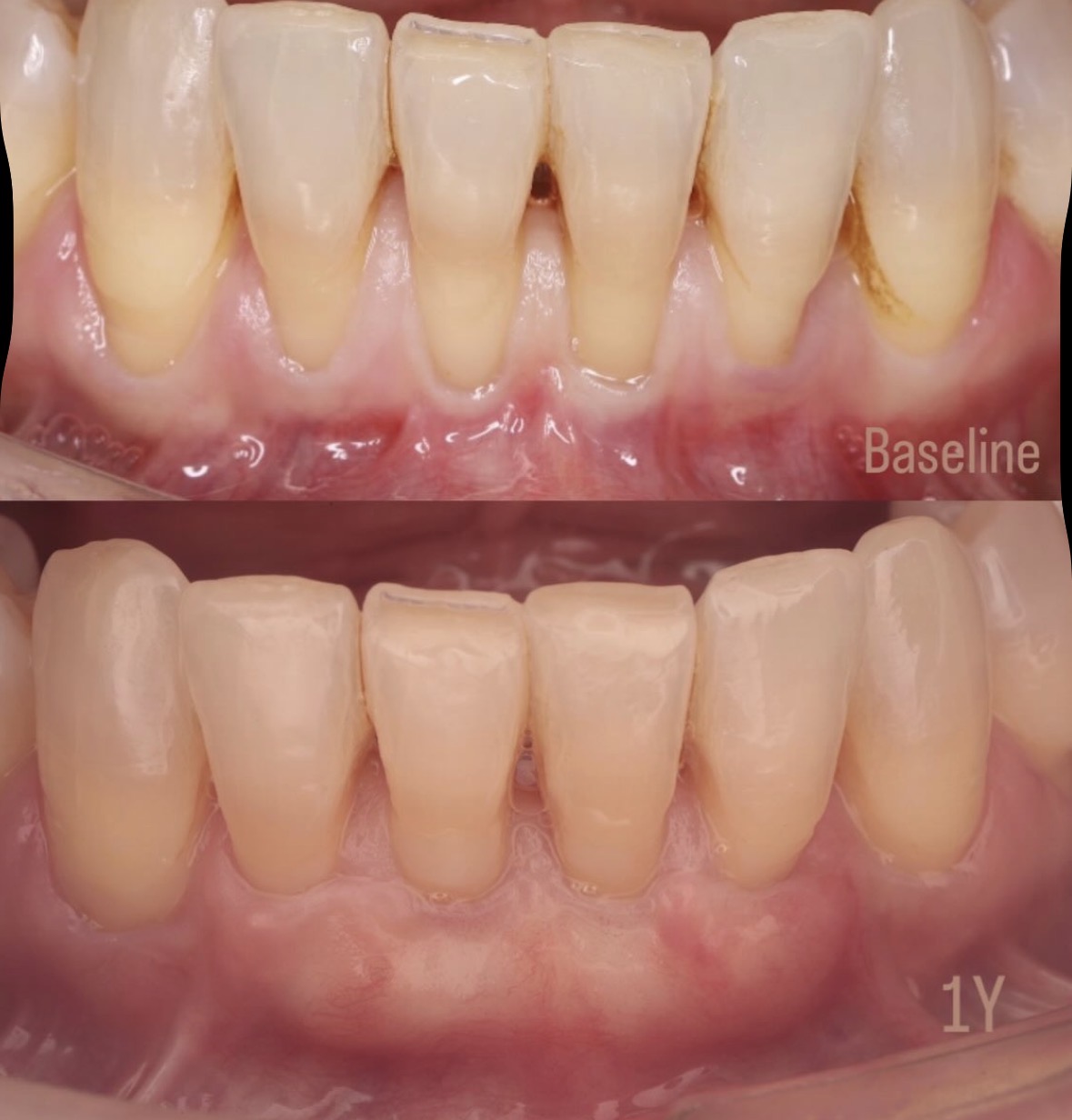 Recesiones gingivales múltiples — injerto de conectivo