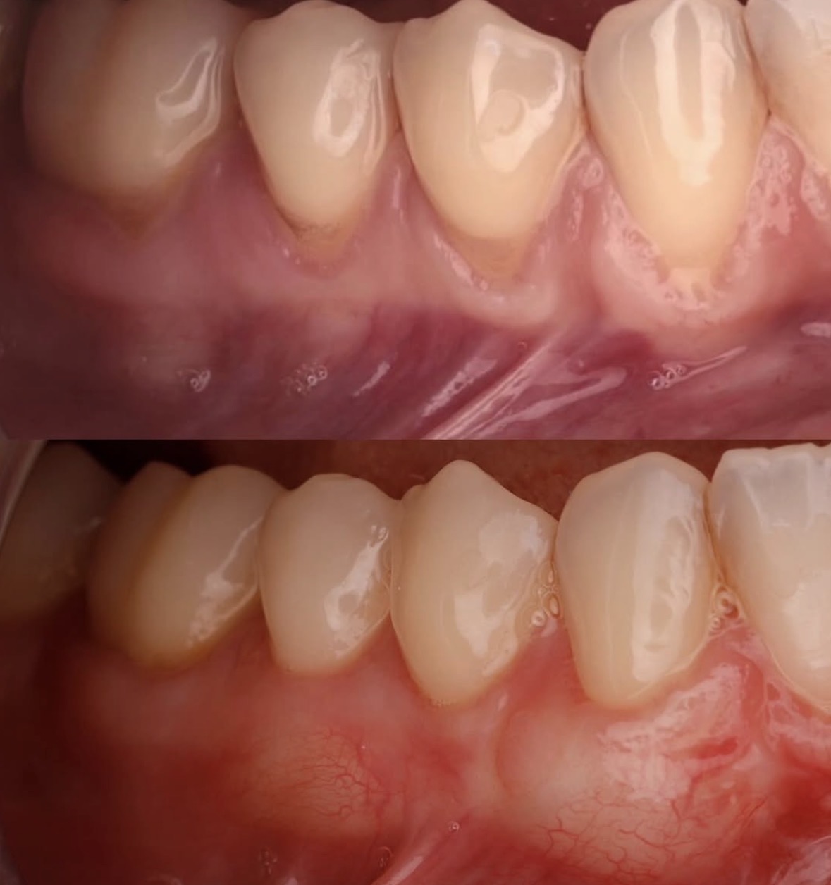 Caso clínico de recesión gingival en Madrid — recubrimiento radicular