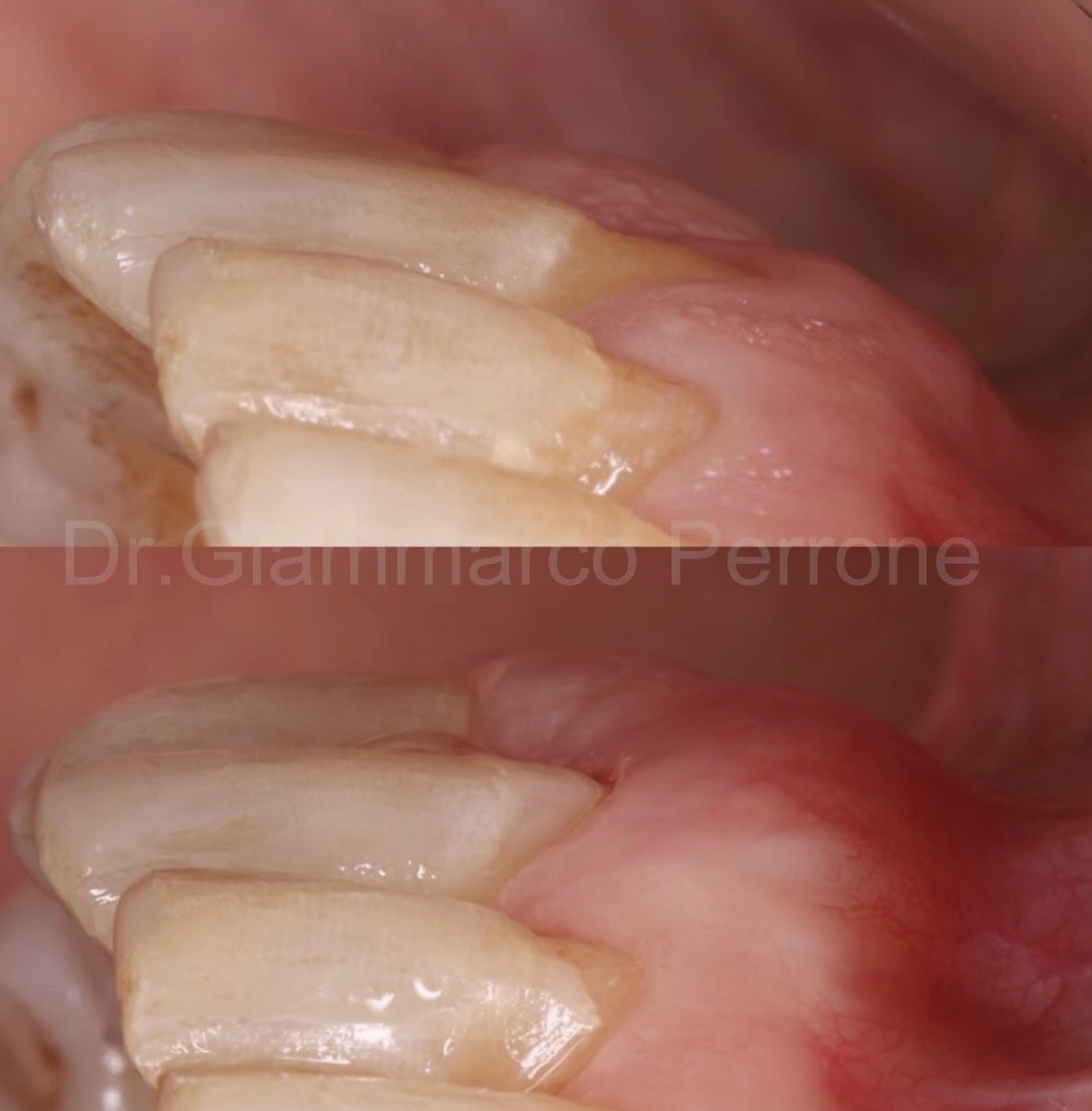 Recubrimiento radicular incisi