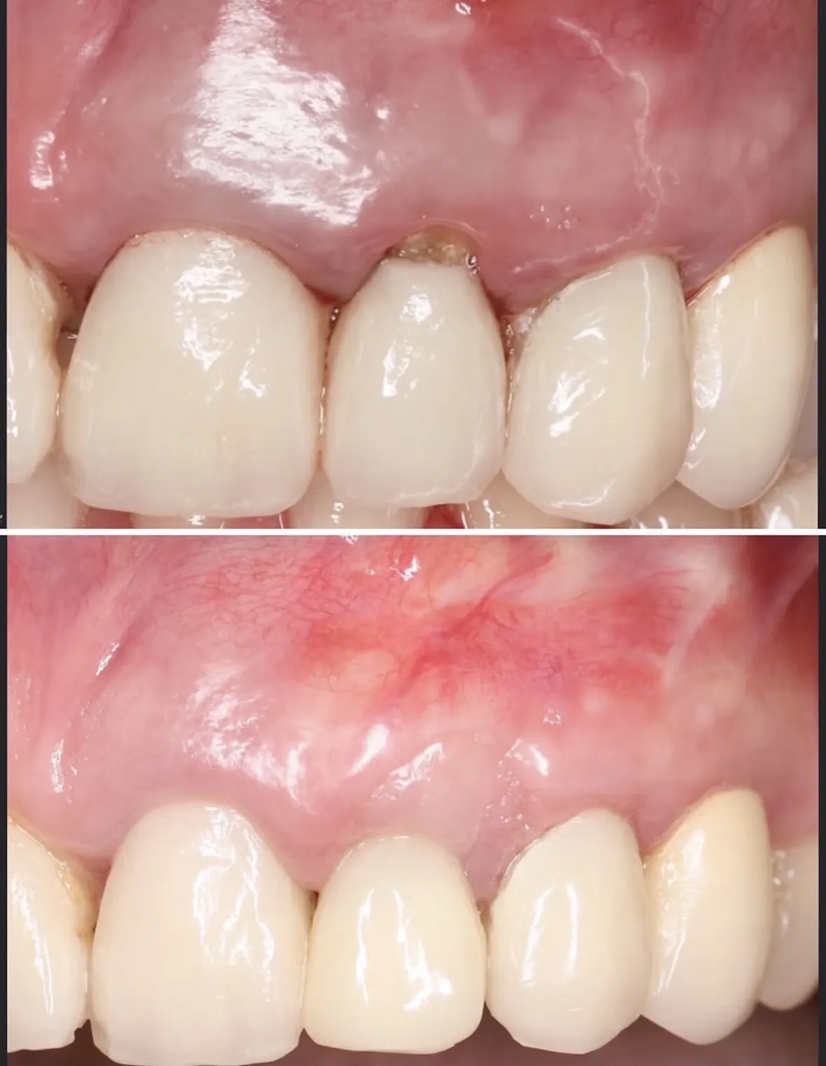 Carga inmediata en incisivo lateral fracturado