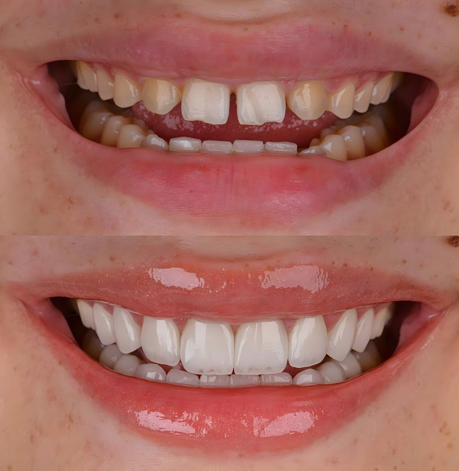 Sonrisa con carillas de alta estética