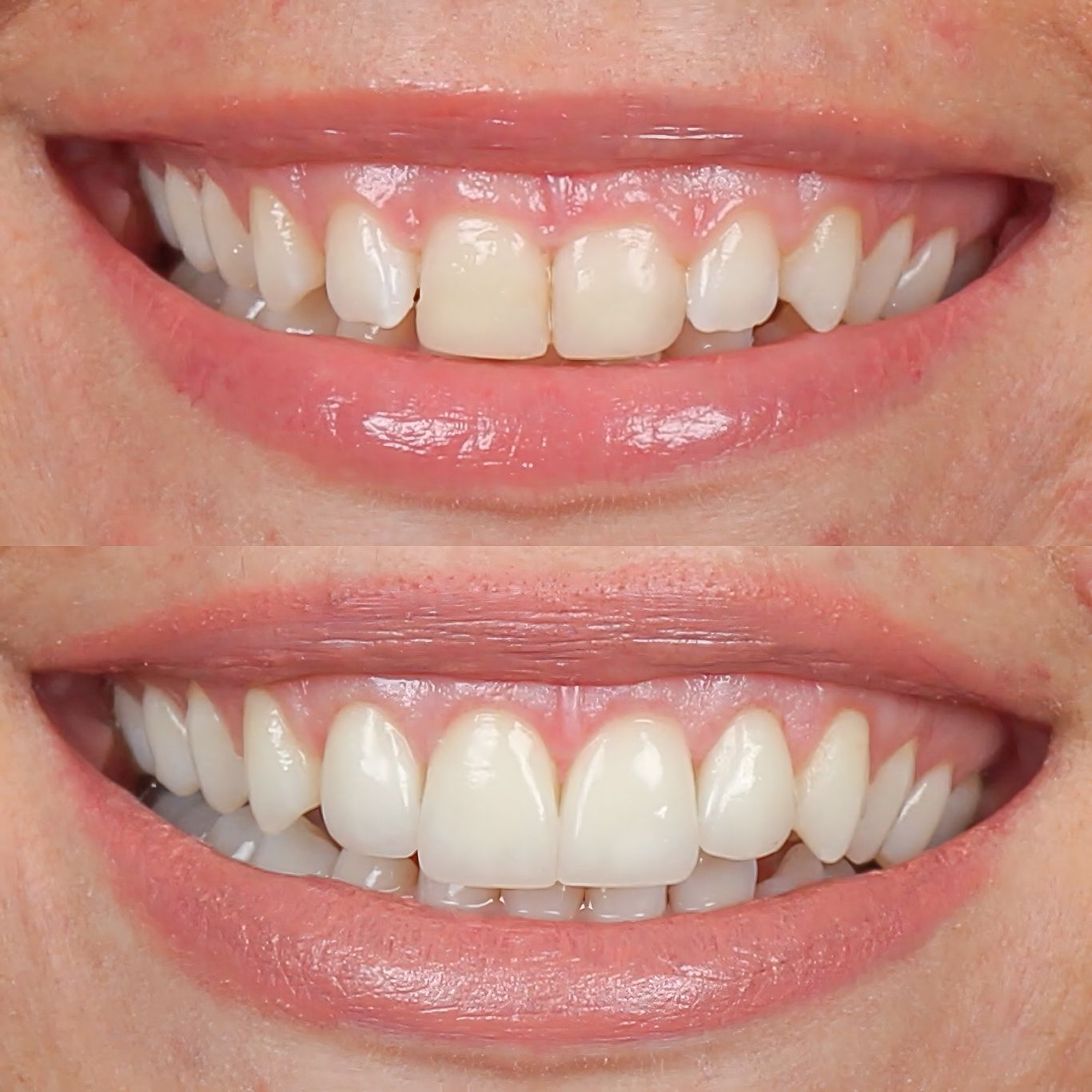 Smile design