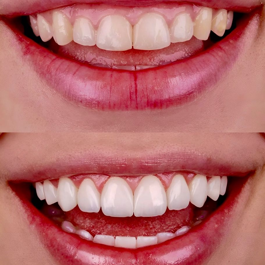 Diseño de sonrisa