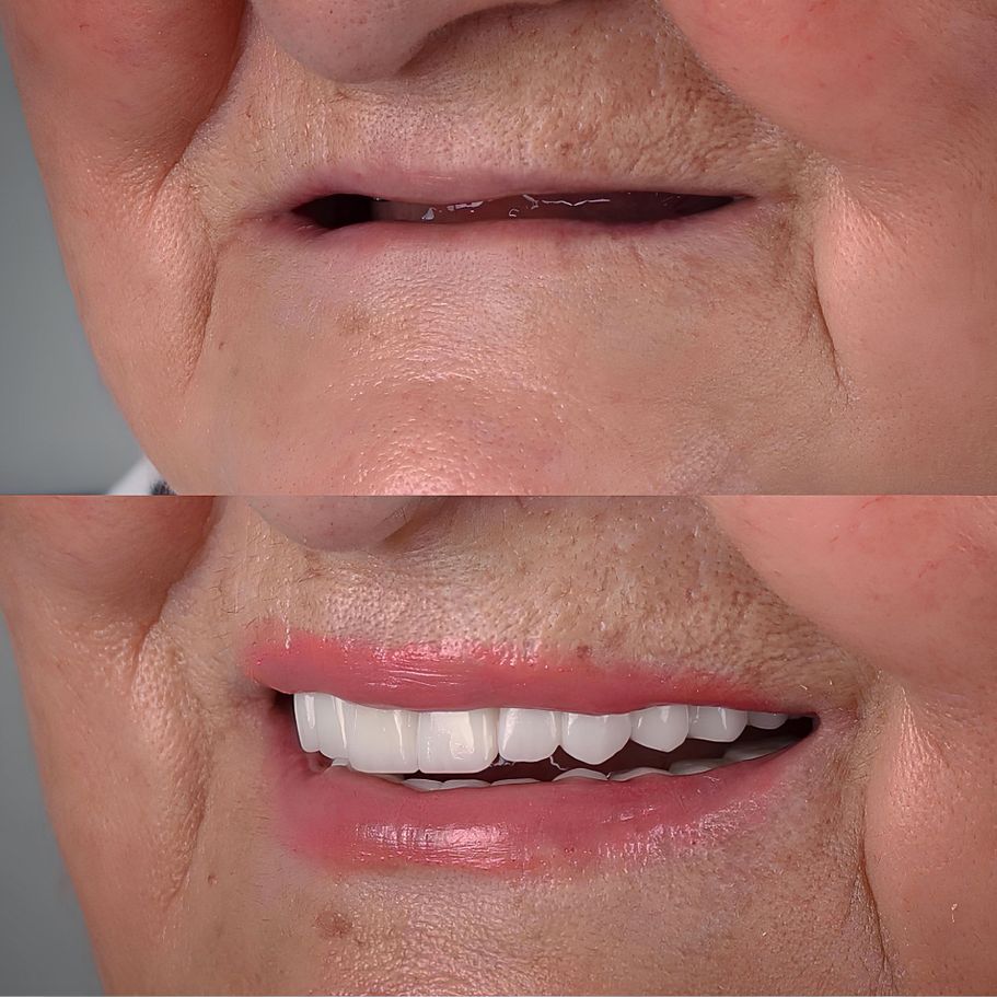 Straumann implant