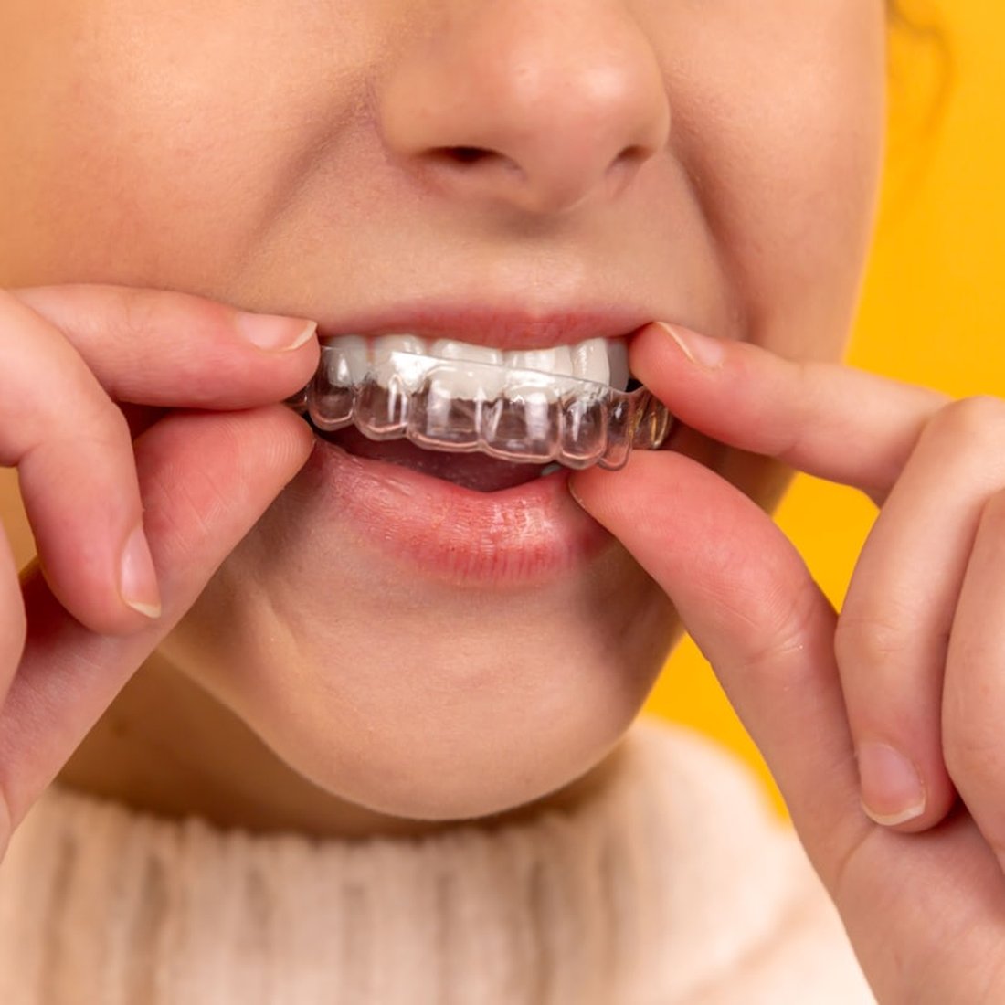 Brackets estéticos