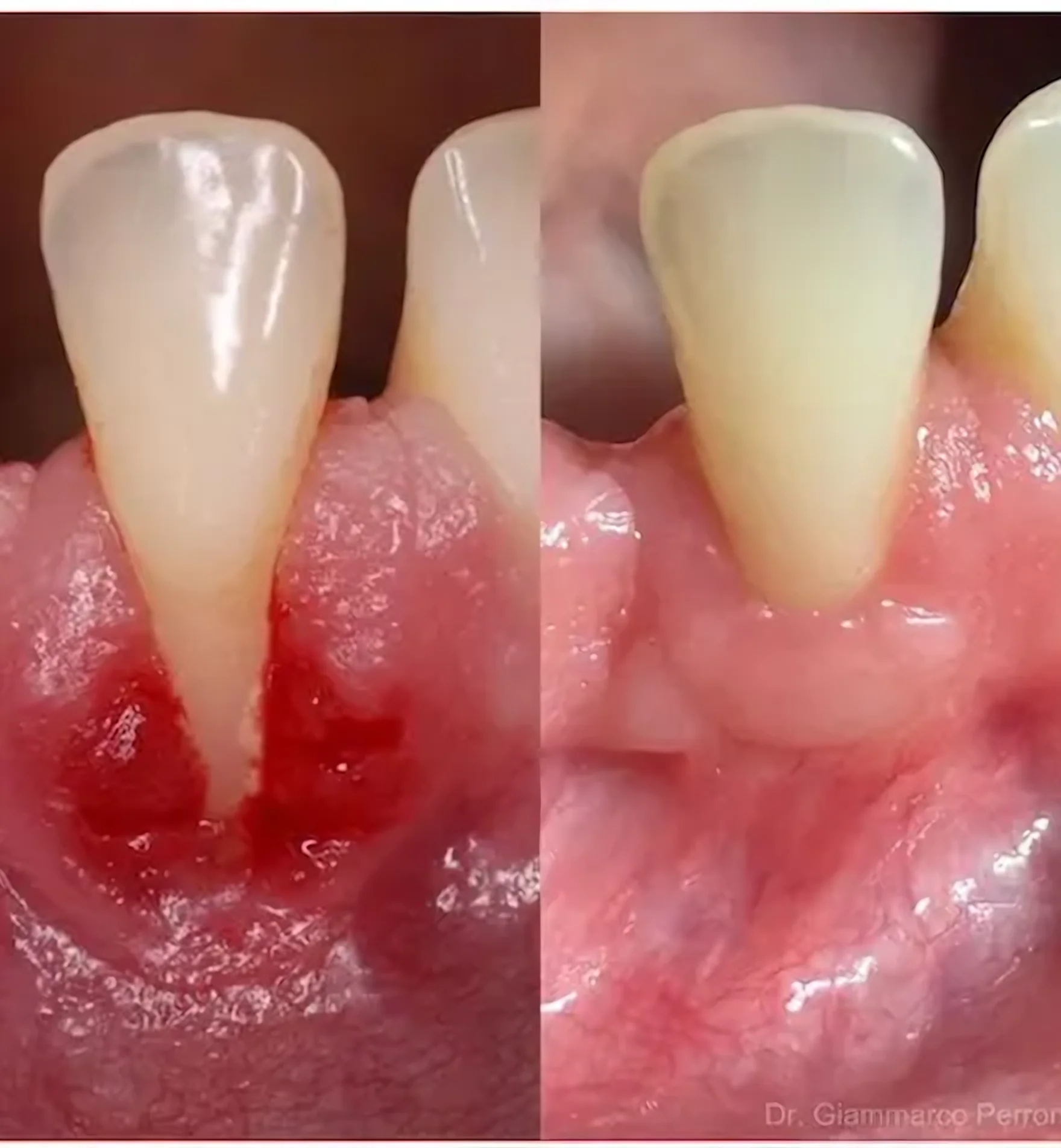 Caso clínico de periodoncia en Madrid — regeneración y reinserción periodontal