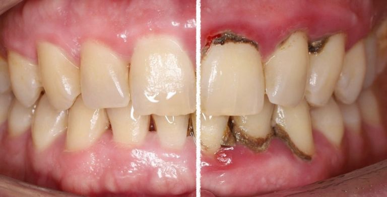Tratamiento de periodontitis avanzada