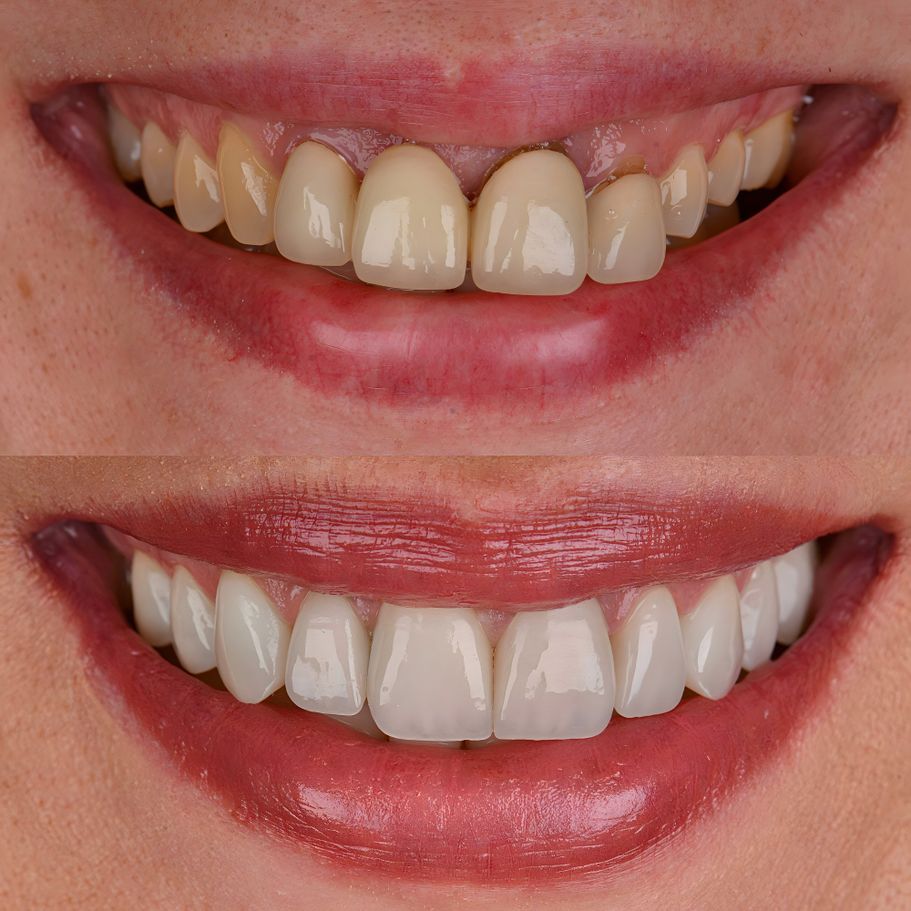 Rehabilitación estética tras tratamiento periodontal
