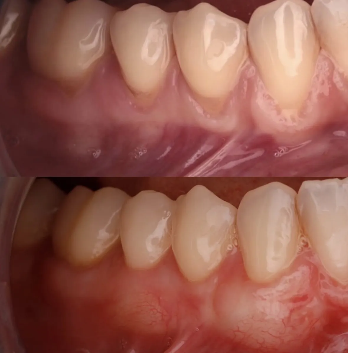 Línea gingival restaurada