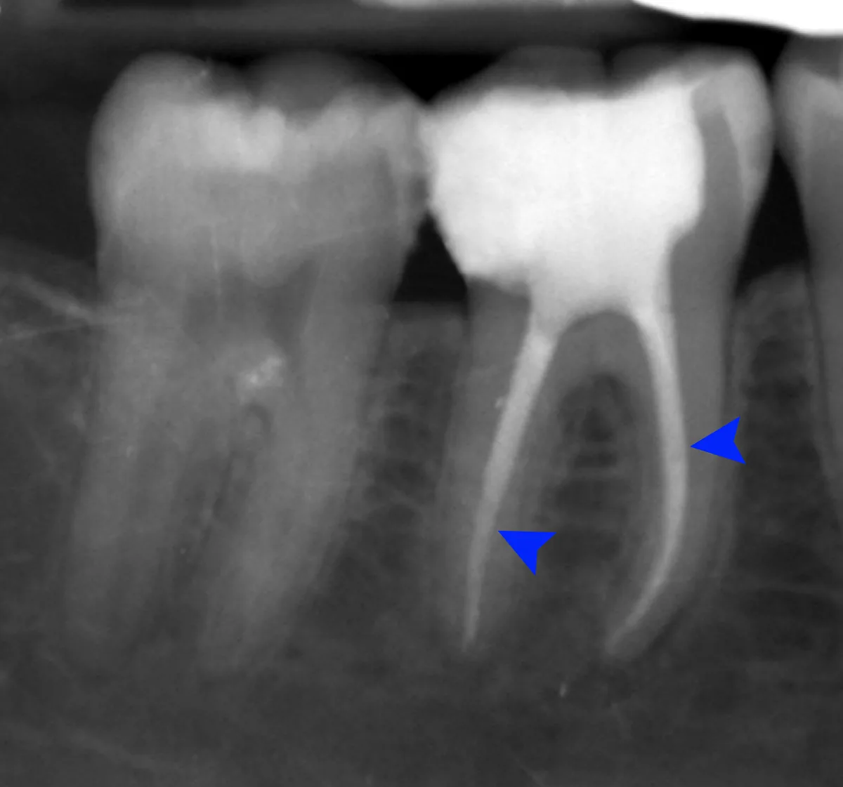 Endodoncia